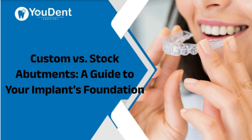 Custom vs. Stock Abutments: A Guide to Your Implant's Foundation
